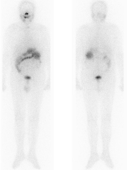 Obr. . 1: Celotlov scintigrafie 4 dny po podn 7,4 GBq 131I 