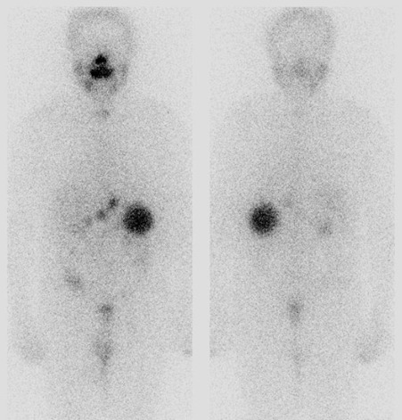 Obr. . 2: Celotlov scintigrafie 5 dn po podn 7,4 GBq 131I