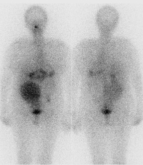 Obr. . 2: Celotlov scintigrafie 6 dn po podn 7,4 GBq 131I - pedn a zadn projekce