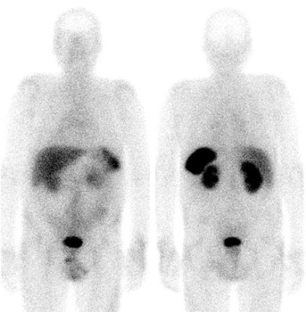 Obr. . 1: Celotlov scintigrafie v pedn a zadn projekci 4 hod. po aplikaci OctreoScanu