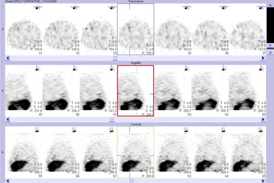 Obr. . 3: Tomografick scintigrafie plic 24 hod. po aplikaci OctreoScanu