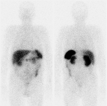 Obr. . 4: Celotlov scintigrafie v pedn a zadn projekci 48 hod. po aplikaci OctreoScanu