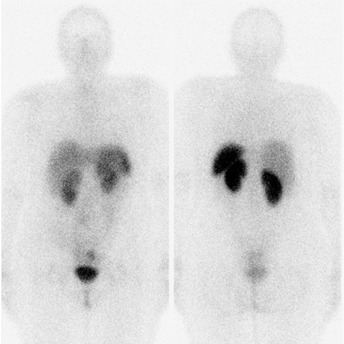 Obr. . 1: Celotlov scintigrafie v pedn a zadn projekci 4 hod. po aplikaci OctreoScanu