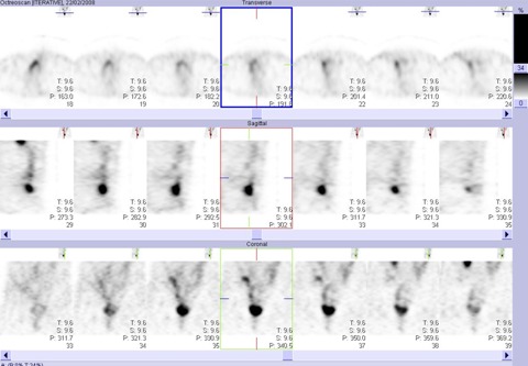 Obr. . 2: Tomografick scintigrafie bicha a pnve 5 hod. po aplikaci OctreoScanu