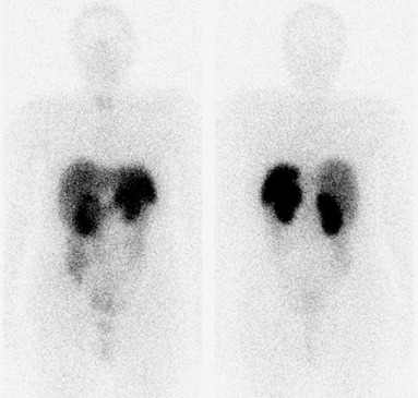 Obr. . 3: Celotlov scintigrafie v pedn a zadn projekci 24 hod. po aplikaci OctreoScanu