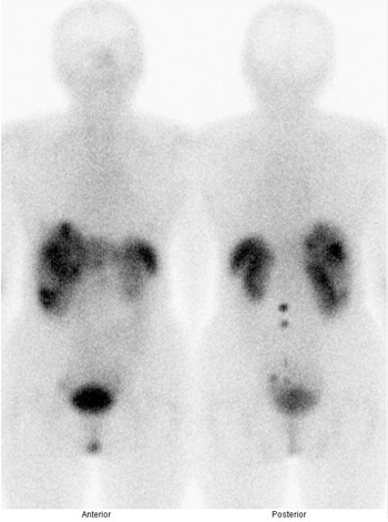 Obr. . 1: Celotlov scintigrafie v pedn a zadn projekci 4 hod. po aplikaci OctreoScanu