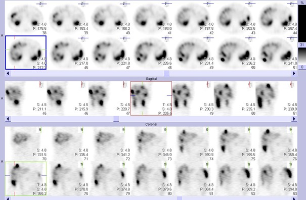 Obr. . 2: Tomografick scintigrafie bicha a pnve 4,5 hod. po aplikaci OctreoScanu