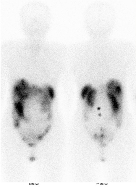 Obr. . 3: Celotlov scintigrafie v pedn a zadn projekci 24 hod. po aplikaci OctreoScanu
