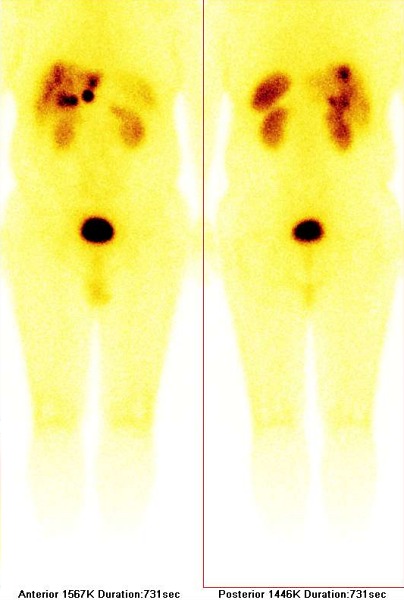 Obr. .1: Celotlov scintigrafie 111In-pentetreotide (OctreoScan) v pedn a zadn projekci