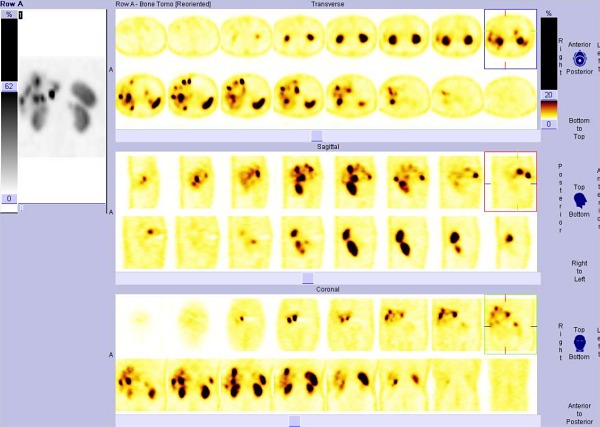 Obr. .2: SPECT bicha 5 hod. po aplikaci 111In-pentetreotide (OctreoScan)