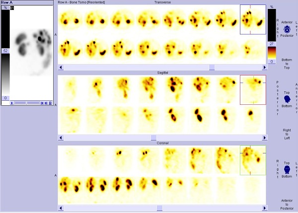 Obr. .3: SPECT bicha 24 hod. po aplikaci 111In-pentetreotide (OctreoScan)