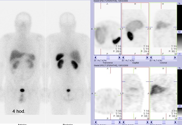 Obr. . 1: Celotlov scintigrafie v pedn a zadn projekci a clen tomografick scintigrafie hrudnku a bicha 4 hod. po aplikaci OctreoScanu