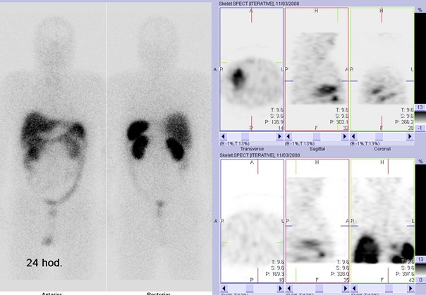 Obr. . 2: Celotlov scintigrafie v pedn a zadn projekci a clen tomografick scintigrafie hrudnku 24 hod. po aplikaci OctreoScanu