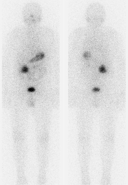 Obr. . 1: Celotlov scintigrafie 4 dny po podn 7,4 GBq 131I - pedn a zadn projekce