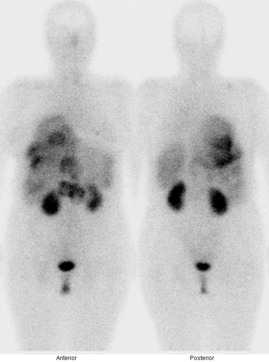 Obr. . 1: Celotlov scintigrafie v pedn a zadn projekci 4 hod. po aplikaci OctreoScanu