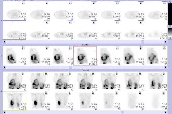 Obr. . 2: SPECT bicha a hrudnku 4 hod. po aplikaci OctreoScanu