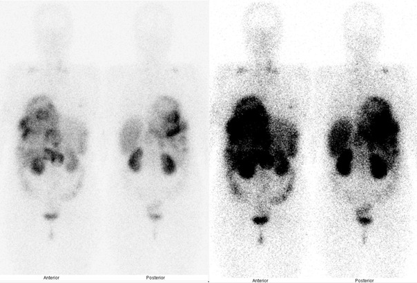 Obr. . 5: Celotlov scintigrafie v pedn a zadn projekci 24 hod. po aplikaci OctreoScanu