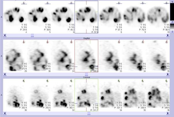 Obr. . 6: SPECT bicha a hrudnku 24 hod. po aplikaci OctreoScanu