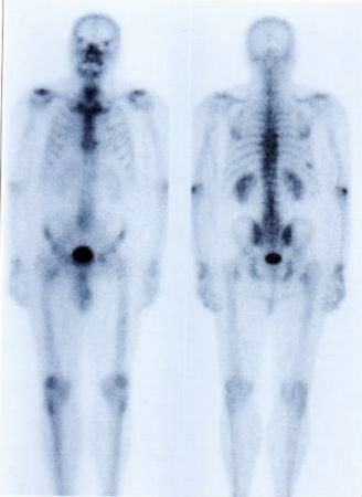 TechneScan HDP - scintigrafie skeletu