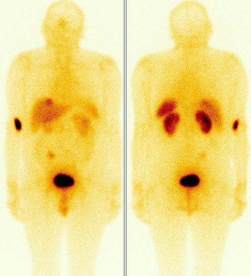 Obr. 1. Celotlov scintigrafie s 111In-pentetreotidem (OctreoScan), pedn a zadn projekce, 4 hodiny po i.v. aplikaci radiofarmaka.