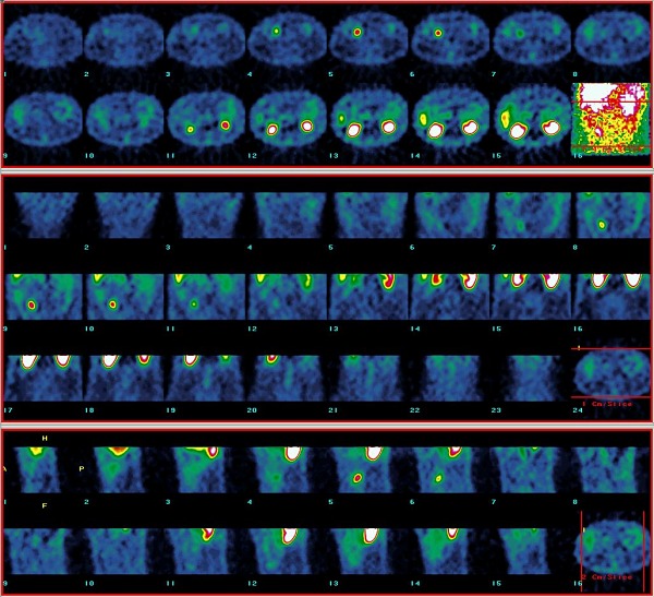 Obr. 3. SPECT dutiny bin. Loisko primrnho karcinoidu v distlnm ileu