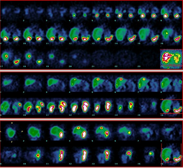 Obr. 6. SPECT jater, metastza karcinoidu v pravm jaternm laloku