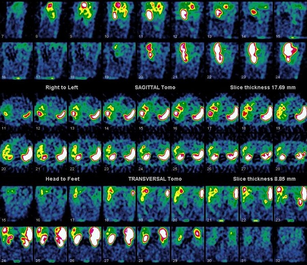 Obr. 2. SPECT jater. Metastzy karcinoidu v jtrech.