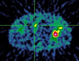 Obr. 10. SPECT dutiny bin, transversln ez