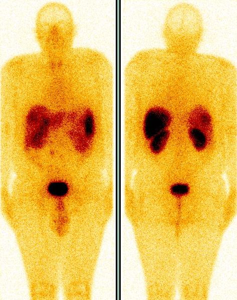 Obr. 1. Celotlov scintigrafie s 111In-pentetreotidem (OctreoScan), pedn a zadn projekce, 4 hodiny po i.v. aplikaci radiofarmaka.