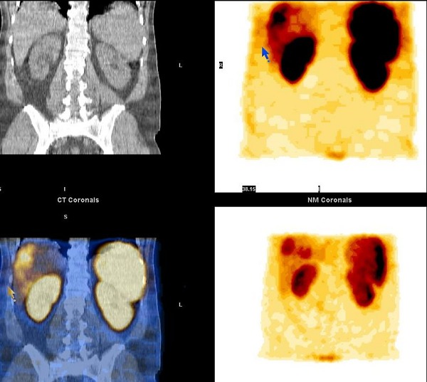 Obr. 13. CT, SPECT/CT a SPECT jater, koronrn ez