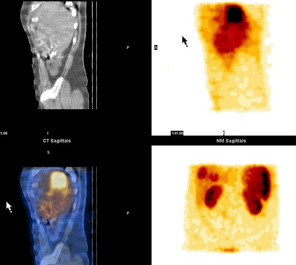 Obr. 14. CT, SPECT/CT a SPECT jater, sagitln ez