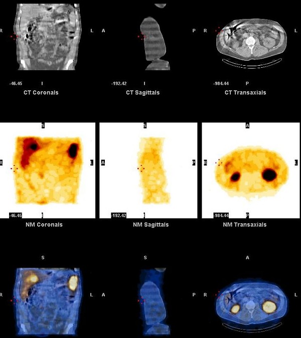 Obr. 15. CT, SPECT, CT/SPECT jater.