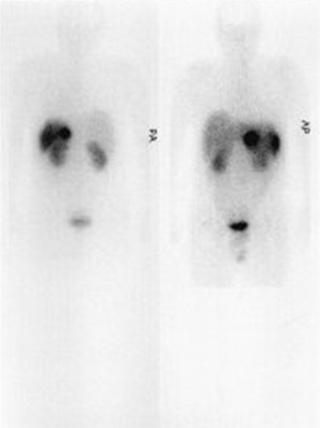 Obr. . 1: Celotlov scintigrafie v zadn a pedn projekci 24 hod. po aplikaci OctreoScanu