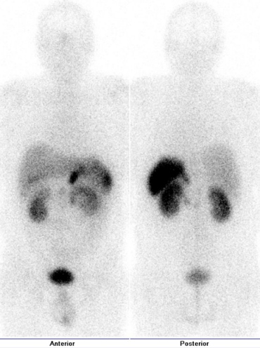 Obr..4: Celotlov scintigrafie v pedn a zadn projekci 5 hod. po aplikaci OctreoScanu