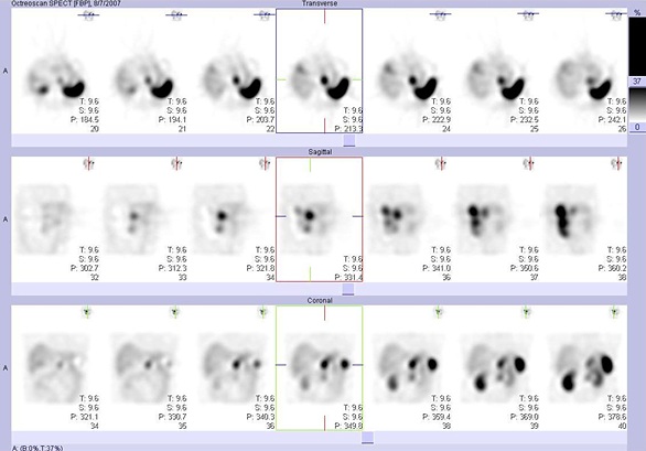 Obr..5: SPECT bicha 5 hod. po aplikaci OctreoScanu.