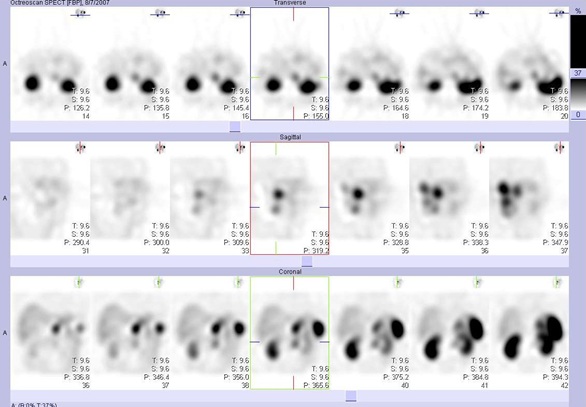 Obr.6: SPECT bicha 5 hod. po aplikaci OctreoScanu.