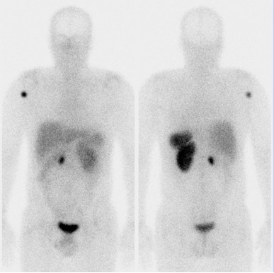 Obr. . 1: Celotlov scintigrafie v pedn a zadn projekci 4 hod. po aplikaci OctreoScanu
