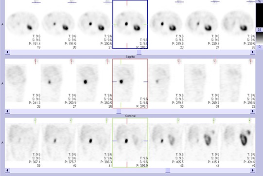 Obr. č. 2: Tomografická scintigrafie břicha a pánve 4,5 hod. po aplikaci OctreoScanu