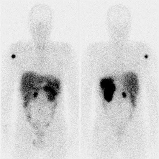 Obr. . 3: Celotlov scintigrafie v pedn a zadn projekci 24 hod. po aplikaci OctreoScanu