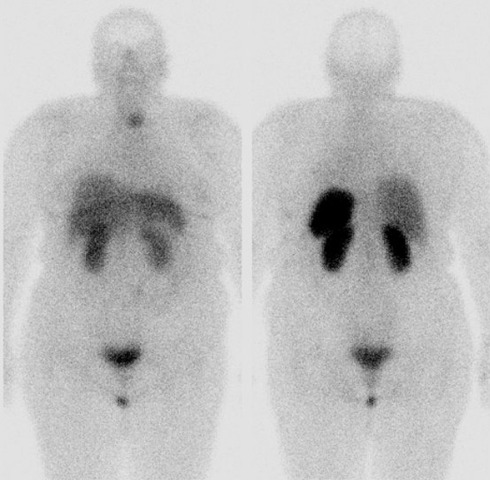 Obr..1: Celotlov scintigrafie v pedn a zadn projekci 4 hod. po aplikaci OctreoScanu