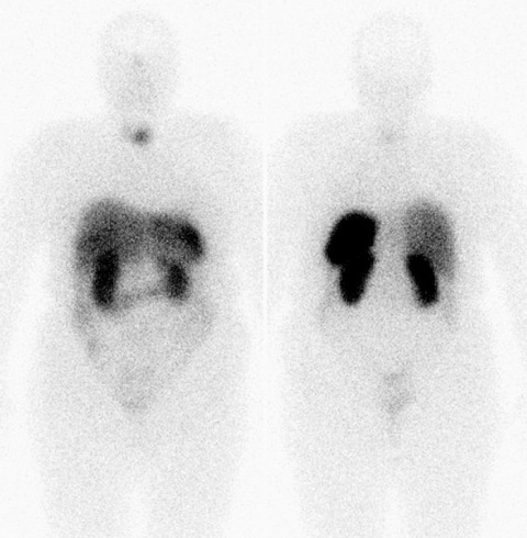 Obr..2: Celotlov scintigrafie v pedn a zadn projekci 24 hod. po aplikaci OctreoScanu