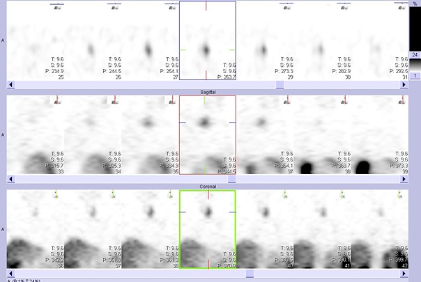 Obr.č.3: Tomografická scintigrafie krku a hrudníku 24 hod. po aplikaci OctreoScanu se zaměřením na oblast štítné žlázy