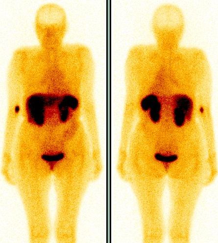 Obr. 1. Celotlov scintigrafie s 111In-pentetreotidem (OctreoScan), pedn a zadn projekce, 4 hodiny po i.v. aplikaci radiofarmaka.