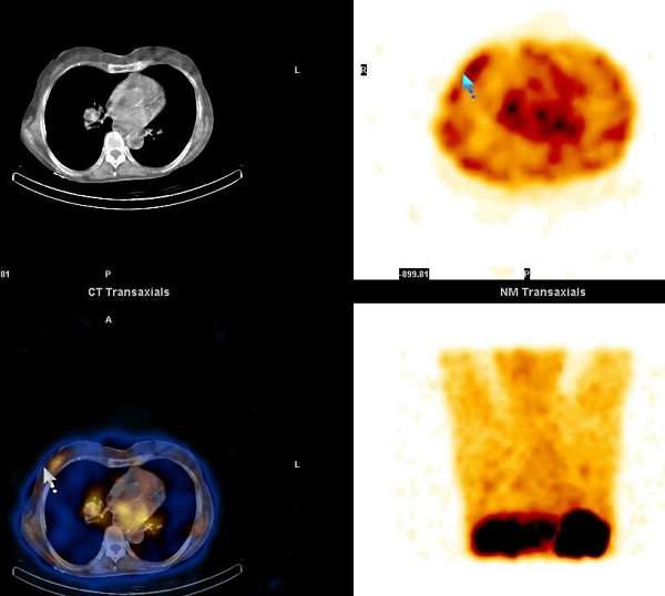 Obr. 10. SPECT, CT, SPECT/CT dutiny hrudn, transverzln ezy