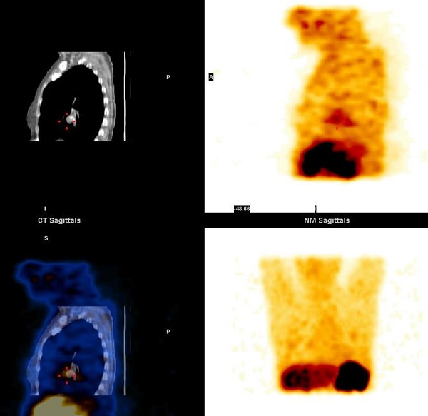 Obr. 11. SPECT, CT, SPECT/CT dutiny hrudn, sagitln ezy