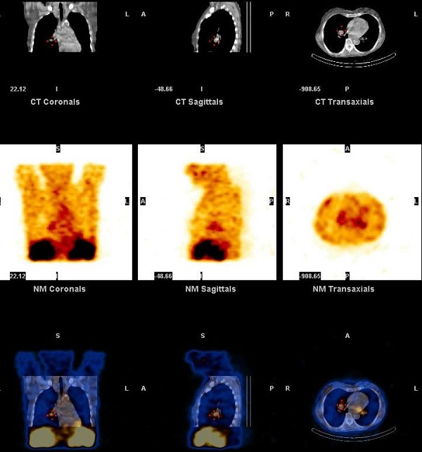 Obr. 12. SPECT, CT, SPECT/CT dutiny hrudn