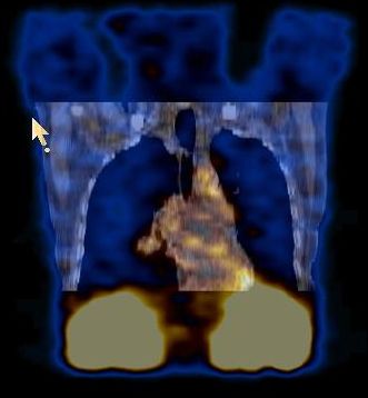 Obr. 9. SPECT/CT dutiny hrudn, koronrn ez, fze obraz.