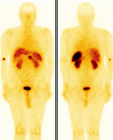 Obr. 1. Celotlov scintigrafie s 111In-pentetreotidem (OctreoScan), pedn a zadn projekce, 4 hodiny po i.v. aplikaci radiofarmaka.