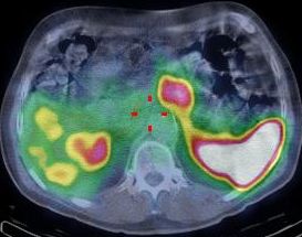 Obr. 11. SPECT/CT dutiny bin, stejn transverzln ez jako na obr. 9 a 10, fze obraz