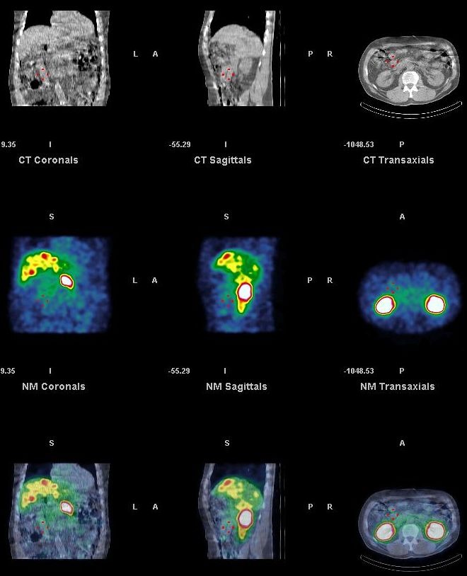 Obr. 15. SPECT, CT a SPECT/CT dutiny bin